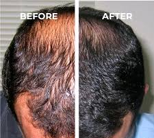 before and after using Folifort supplement.